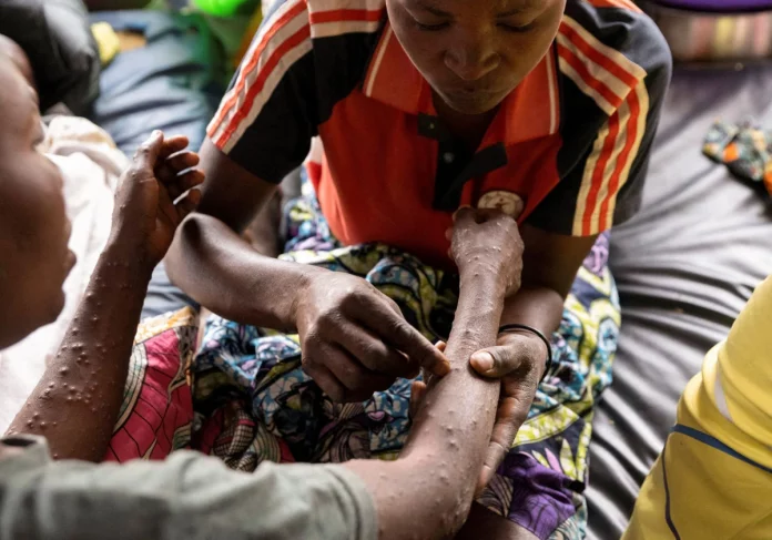 viruela-R0o2OJJfQCpRy0a7bzPlmfM-1200x840@diario_abc