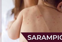 Sarampión: prioridades que dejan secuelas